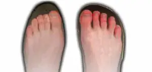 causes of wide feet