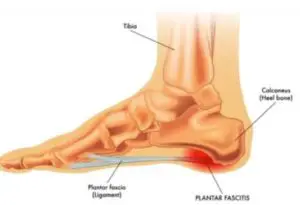 what are the causes of plantar fasciitis