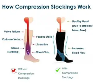 how do compression sock work
