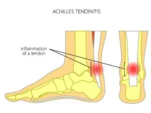 causes of achilles tendonitis