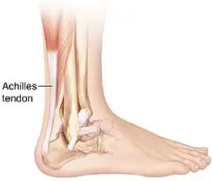causes of Achilles tendonitis