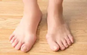 causes of bunions and flat feet