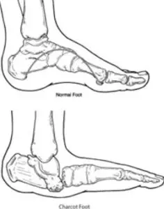 causes of charcot foot