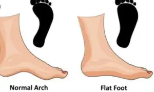 causes of flat feet