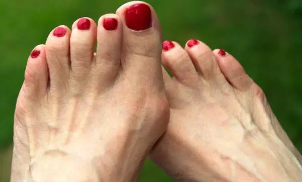 definition of bunions feet